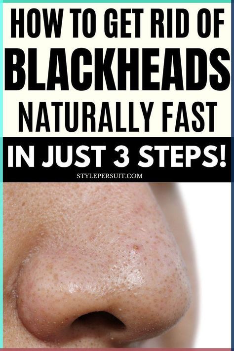 Blackheads Popping Videos Faces, Blackheads On Face, Blackhead Remover Diy, Blackhead Remedies, Blackheads On Nose, Rid Of Blackheads, Black Heads, Blackhead Mask, Clean Blackheads