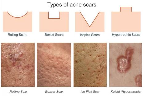 Laser Acne Scar Removal, Skincare Marketing, Acne Laser, Hypertrophic Scars, Beauty Journal, Skin Facts, Acne Overnight, Ayurveda Yoga, Acne Skincare