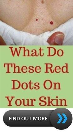 What do these red dots on your skin mean. Red Dots On Skin, What Is Health, Summer Health, Healthy Remedies, Health Signs, Women Health Care, Health Tips For Women, Daily Health Tips, Natural Health Tips