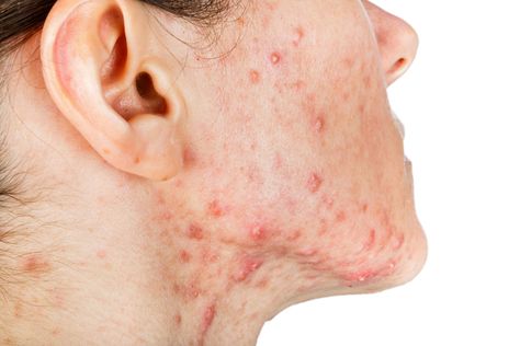 Treating Cystic Acne, Cystic Acne Remedies, Chest Acne, Face Mapping Acne, Problem Skin, Natural Face Mask, Home Remedies For Acne, Acne Causes, Hormonal Acne