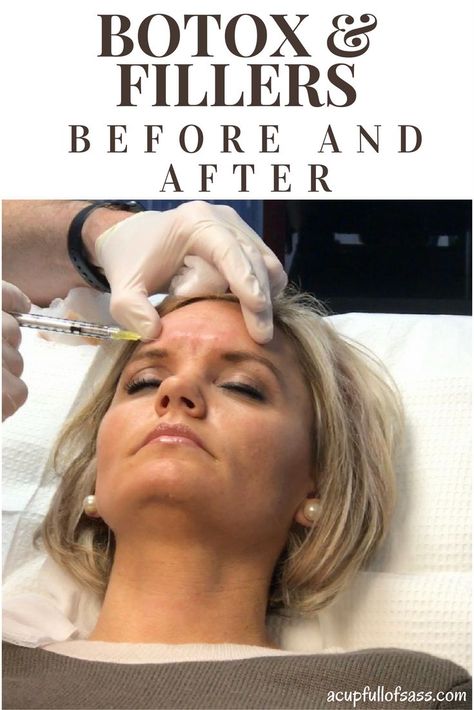 Botox Eyes, Botox Under Eyes, Best Wrinkle Filler, Botox Forehead, Botox Injection Sites, Derma Fillers, Botox And Fillers, Botox Brow Lift, Under Eye Fillers