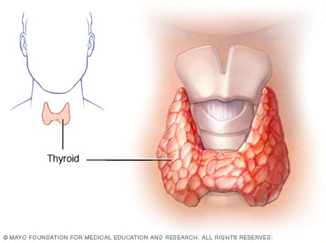 Hashimoto's disease - Symptoms and causes - Mayo Clinic Hashimotos Disease Symptoms, Low Thyroid Remedies, Thyroid Remedies, Low Thyroid, Thyroid Symptoms, Hashimotos Disease, Graves Disease, Disease Symptoms, Thyroid Gland