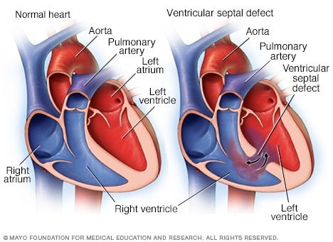 Illustration showing ventricular septal defect Transposition Of The Great Arteries, Patent Ductus Arteriosus, Digeorge Syndrome, Cardiothoracic Surgery, Heart Warrior, Mitral Valve, Chd Awareness, Normal Heart, Congenital Heart Defect