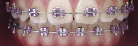 Braces Funny, Dental Braces Colors, Invisible Teeth Braces, Braces Colors Combinations, Braces And Glasses, Lingual Braces, Braces Smile, Black Braces, Teeth Aesthetic