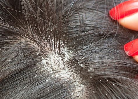 Hair Fall And Dandruff Remedy, Bad Dandruff How To Get Rid Of, How To Stop Dandruff And Hairfall, What To Do If You Have Dandruff, Prevent Dandruff, Bad Dandruff, Treat Dandruff, What Causes Dandruff, Severe Dandruff