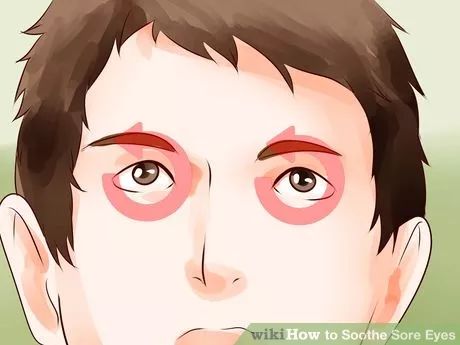 Image titled Soothe Sore Eyes Step 5 Sore Eyes Remedy, Salt Pool, Irritated Eye, Watery Eyes, Sore Eyes, Wearing Glasses, Eye Strain, Your Eyes, Things That