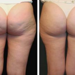 Getting Rid Of Cellulite On Legs The face, hands, and legs. The following things can be done to help you make a and/or improve cellulite areas. If you have six months or more: a) Do all the  View This Document http://www.gettingridcel... How To Get Rid Of Cellulite Skin Roller, Skin Needling, Skin Tightening Face, Stretch Mark Removal, Anti Aging Wrinkles, Growing Grapes, Derma Roller, Skin Tightening, Body Treatments