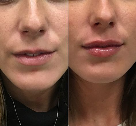 #lipspiration from these luscious lips, injected in October. Notice how the added fullness in her top lip gives her lips more balance and helps to removes the appearance of lines in the bottom lip 💋 Lip Filler On Small Lips, Lip Inspiration, Full Lips Makeup, Lips Fillers, Lip Flip, Lip Lift, Lips Inspiration, Botox Lips, Facial Fillers