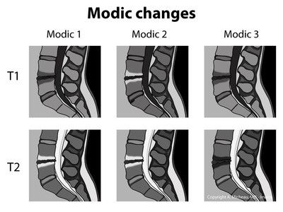 Image courtesy of Google Images Spinal Degeneration, Mri Technologist, Radiology Student, Medical Mnemonics, Radiology Imaging, Spinal Surgery, Brain Anatomy, Spine Health, Spine Surgery