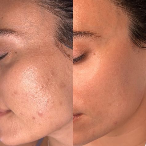 Look at these wonderful results achieved by esthetician @bonnie_frances_skin 🙌 Using Lira Clinical products, of course. 😉⁠ ⁠ Big thanks to Bonnie for sharing her client's incredible skincare journey with us. It's easy to feel overwhelmed or unsure about how to approach certain skin concerns, but this story is a powerful reminder of the transformative impact that consistency and dedication can have on our skin!✨⁠ ⁠ Share and tag us in your clients before & after photos. We love to see them. 😍⁠ Acne Before After, Skin Before After, Esthetician Before And After, Skin Care Before And After, Before And After Skin Care Pictures, Skin Before And After, Dermapen Before And After, Before And After Skincare, Acne Before And After