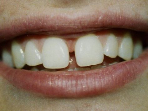 Teeth Gaps Aesthetic, Teeth Aesthetic, Loose Tooth, Gap Teeth, Perfect Teeth, Oil Pulling, White Smile, Natural Teeth Whitening, Perfect Smile