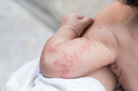 Are you uncertain about your baby's persistent rashes? Here's how to tell if it's no cause for worry or if you need to see your baby's pediatrician immediately Shingles Remedies, Healthy Diet For Kids, Baby Rashes, Baby Skin Rash, Baby Food Allergies, Diet For Kids, Food For Children, Baby Acne, Skin And Hair Clinic