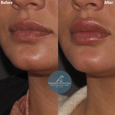 ✨ JUNE PROMO: $100 OFF Restylane Lip Filler & receive a free Lip Kit! 🙌🏻 Top 1% of Juvéderm & BOTOX facilities in the nation. 💉Expert Injector & Top Beauty Doctor in @newbeauty 💵Cost: $600-$700 📞Phone: (203) 637-0662 📩Email: greenwichmedicalspa@gmail.com 💻Website: http://www.greenwichmedicalspa.com/ 📍Location: Greenwich - Westport, CT & Scarsdale NY ✏️Note: Individual Results May Vary  #GreenwichMedicalSpa #GMS #LipInjections #WestportCT #NewYork #ScarsdaleNY #ScarsdaleNY Lip Filler Before And After Black Women, Top Lip Filler, Restylane Lips, Beauty Doctor, Westport Ct, Lip Filler, Makeup Stuff, Lip Injections, Top Beauty