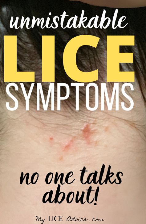 Discover 17 common head lice symptoms with pictures and find out the early and late signs of lice and use these fool-proof ways to figure out whether or not you have lice. Lice Hairstyles, Natural Remedies For Lice, Lice Remedies How To Get Rid Of, Lice Spray For Furniture, Essential Oils For Lice, Lice Facts, Itchy Scalp Remedy, Lice Spray, How To Treat Lice