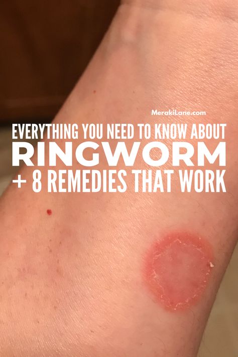 Ring Worm Remedies How To Get Rid, How To Get Rid Of Ring Worms On Skin, Natural Ring Worm Remedies, Ringworms In Humans Remedies, How To Get Rid Of Ring Worm Fast, Ringworms In Humans Pictures, Ringworms In Humans, Ring Worm Remedies, Fungal Rash