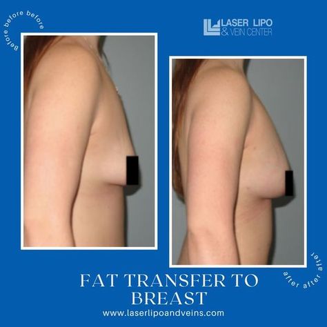 Fat Transfer To Breast, Increase Breast Size, Laser Lipo, Fat Transfer, Most Asked Questions, Cosmetic Procedures, Breast Augmentation, Before And After Pictures, Cosmetic Surgery