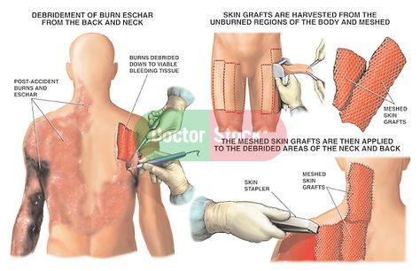 Post-accident Burns of the Back and Neck with Skin Grafting. Skin Grafting, Medical Anatomy, Making Faces, Hearing Loss, Natural History, Anatomy, The Natural, Literature, Medical