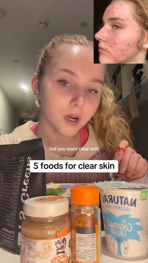 5 foods of clear skin How To Improve Acne, Skincare Bumpy Skin, Hiding Acne With Makeup, Natural Acne Scar Remedy, Even Out Skin Tone Naturally, How Is Your Skin So Clear, Tips For Glowy Skin, How To Have Beautiful Skin, Tea For Acne Clear Skin