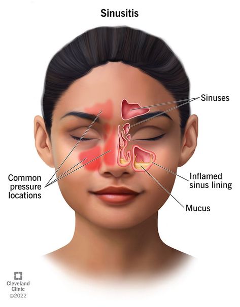 Swelling Remedies, Sinus Pressure Relief, Remedy For Sinus Congestion, Hangover Headache, Home Remedies For Sinus, Relieve Sinus Pressure, Home Remedies For Bronchitis, Sinus Congestion Relief, Sinus Cavities