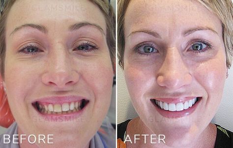 Porcelain Veneers Before & After Results : Glamsmile Porcelain Veneers Before And After, Veneers Before And After, Nose Job Inspo, Cosmetic Dentistry Procedures, Making Cosmetics, Porcelain Veneers, Dental Laboratory, Makeover Before And After, Dental Cosmetics