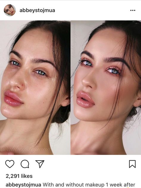 Lip goals...Lip fillers Lip Injections Juvederm, Lip Goals, Botox Lips, Nose Surgery, Facial Plastic Surgery, Lip Filler, Facial Plastic, Lip Shapes, Lip Injections