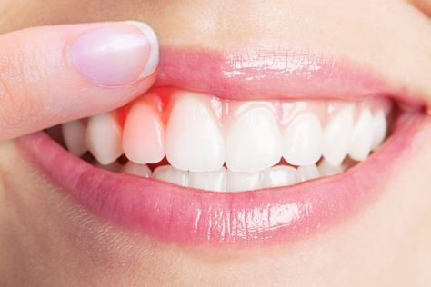 Gum disease is one of the most common oral problems. Here’s how you can keep your gums healthy in 5 easy steps. Tips to Keep Your Gums and Teeth Healthy. Gum Surgery, Holistic Dentistry, دورة شهرية, Swollen Gum, Laser Teeth Whitening, Loose Tooth, Dental Bridge, Dental Crowns, Periodontal Disease