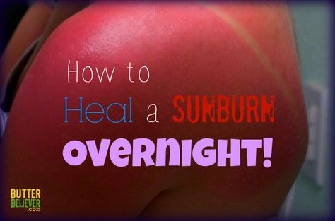 How to Heal a Sunburn Overnight with Two Simple Ingredients - I have used this to great success but we rarely get burned using coconut oil as sun protection. Heal Sunburn, Sickness Remedies, Burn Relief, Diy Medicine, Sunburn Remedies, Sunburn Relief, Sun Safety, Diy Remedies, Beach Please