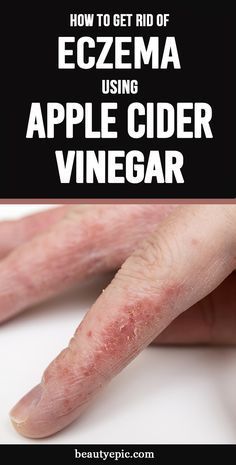 5 Effective Ways to Use Apple Cider Vinegar for Eczema Apple Cider Vinegar Remedies, Cider Vinegar Benefits, Home Remedies For Warts, Warts Remedy, Apple Cider Vinegar Benefits, Apple Cider Vinegar Drink, Natural Cold Remedies, Natural Cough Remedies, Cider Vinegar