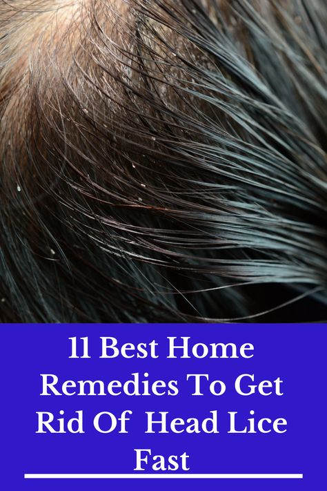 11 Best Home Remedies To Get Rid Of Head Lice Fast Getting Rid Of Nits, Lice Remedies, Lice Nits, Hair Lice, Dark Eye Circles, Head Louse, Fast Hair, Home Remedies For Hair, Fast Hairstyles