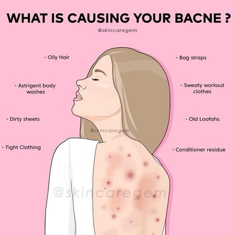 Struggling with back acne? Here are the possible causes Charlotte Tillbury, Wedding Skincare, Back Acne, Hotel Hacks, Oily Skin Acne, Skincare Routines, Sweaty Workouts, Acne Causes, Body Acne