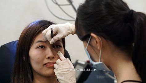 Dr Rachel Ho | How to Get Rid of Eye Bags Without Surgery: Under Eye/ Tear Trough Fillers Get Rid Of Eye Bags, Rid Of Eye Bags, Eye Tear, Under Eye Fillers, Tear Trough, Cheek Fillers, Post Inflammatory Hyperpigmentation, Tears In Eyes, Dark Eye Circles