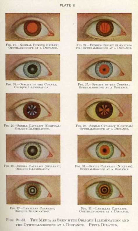 vintage illustration - diagnosing eye conditions based on reflection of light through the pupil Eye Facts, Behind Blue Eyes, Human Eye, Arte Inspo, Medical Illustration, Eye Art, Eye Drawing, Journal Ideas, The Eye