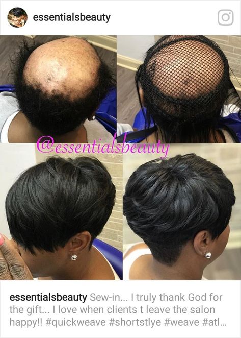 Alopecia hair styles Quick Weave On Bald Head, Short Sew In Hairstyles, Hairstyling Tips, Alopecia Hair Growth, Quick Weaves, Short Weave Hairstyles, Alopecia Hairstyles, Black Women Short Hairstyles, Sew In Hairstyles