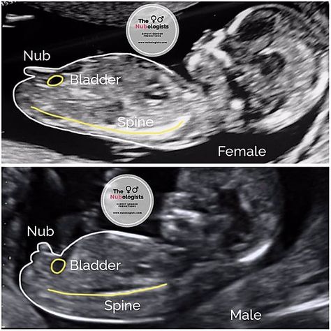 The Nub Theory, examples of a male and female nub. Ultrasound Boy Or Girl, 10 Week Ultrasound Pictures, Ultrasound Pictures Gender, Baby Gender Ultrasound, Boy Ultrasound Pictures, Ultrasound Gender Prediction, Ultrasound Gender, Nub Theory, Diagnostic Medical Sonography Student