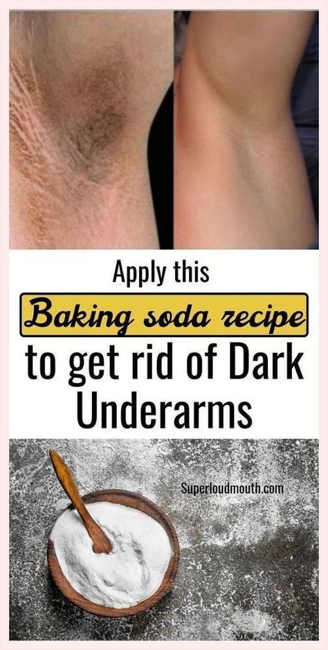 How to Lighten Dark Underarms Fast with 2 Natural Ingredients Baking Soda Underarm, Whiten Underarms Fast, Rid Of Dark Underarms, Baking Soda Dry Shampoo, Baking Soda For Dandruff, Baking Soda And Honey, Baking Soda Shampoo Recipe, How To Whiten Underarms, Baking Soda For Hair