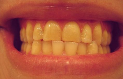 5 Ways to Get Rid of Yellow Teeth | HubPages Get Rid Of Yellow Teeth, Make Teeth Whiter, Coffee Stain Removal, Homemade Mouthwash, Plaque Teeth, Teeth Whitening Remedies, Yellow Teeth, Dental Veneers, Acidic Foods