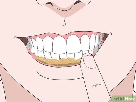 3 Simple Ways to Treat a Gum Infection - wikiHow Sore Gums Remedy, Swollen Gums Remedy, Gum Sores, Reverse Receding Gums, Remedies For Dry Mouth, Dental Routine, Dental Infection, Tooth Infection, Gum Inflammation