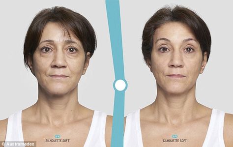 I HAD A THREAD LIFT - THIS IS WHAT HAPPENED - Thread Lift Face, Facelift Surgery, Face Threading, Facelift Procedure, Non Surgical Facelift, Anti Wrinkle Injections, Face Lift Surgery, Subcutaneous Tissue, Thread Lift