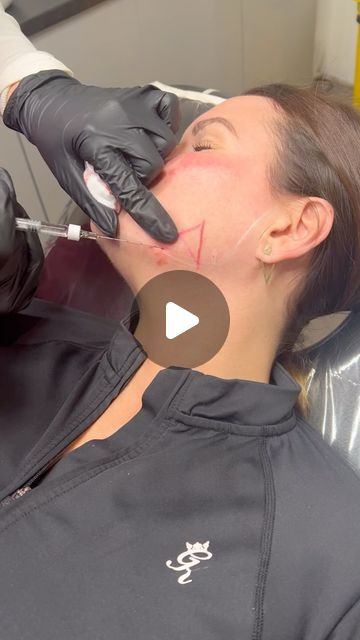 Cassie’s Cosmetics & Training Academy on Instagram: "🄼🄾🄳🄴🄻 🄲🄰🄻🄻.....📣  Snatched Package 5ml filler  Jawline ✔️ cheeks ✔️ chin ✔️ chin dips ✔️ naso folds or lips ✔️ £250!!!!   ( RUNNING FOR 1 WEEK ONLY! Offer ends Monday 12th August T&Cs apply )   Pls DM us to book ✨ .. .. .. .. 📍Wickford Essex  ⭐️CPD training Academy  💜Aesthetics PMU Beauty Slimming  🖤Advanced aesthetics practitioner  🆘Complications Trained   .. .. .. ..  #contourwithfillers#snatchedjawline#facialinjections#slimdownyourface#hyaronicacid#skinrejuvenation#cheekfiller#chinfillers#essexsalon#wickfordaestheticstraining#ukaestheticclinic#advancedaedtheticscenter" Aesthetics Practitioner, Jawline Filler, Chin Filler, Cheek Fillers, Acne Help, Chin Chin, Hormonal Acne, Training Academy, Model Call