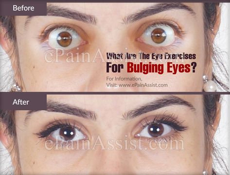 Eyes Exercise, Overactive Thyroid, Bulging Eyes, Swollen Eyes, Graves Disease, Eye Exercises, Magnetic Resonance Imaging, Thyroid Function, Simple Exercises