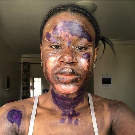 A burn survivor is lucky to have her skin back to normal just 6 months after she was burnt. The Twitter user took to the platform to share side-by-side photos of herself on November  2, 2021 and on May, 2, 2021, six months apart. She had severe burns on her face, neck  and shoulders in November 2021. Fortunately, she has now healed completely and the burns left no blemish. She added that she used honey, aleo vera and other products to restore her skin. See below…   The post Burn Survi Burnt Face, Survivor Show, Side By Side Photo, Severe Burns, November 2, Skin Healing, Side By Side, In November, The Platform