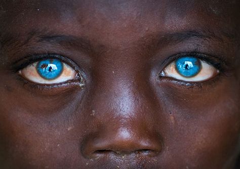 Boy with "Waardenburg syndrome",Ethiopia by Eric Lafforgue Waardenburg Syndrome, People With Blue Eyes, Rare Eye Colors, Rare Eyes, Eye Quotes, Sayings And Quotes, Eyes Artwork, Cute Babies Photography, Skin Hand