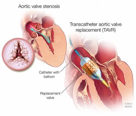 Cardiology Notes, Aortic Valve Replacement, Mitral Valve, Heart Surgeon, Heart Valves, Open Heart Surgery, Cardiac Nursing, Heart Surgery, Medical Knowledge