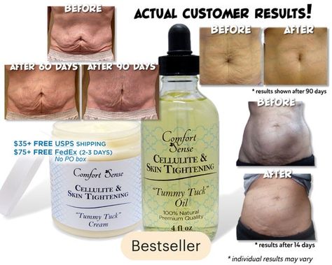 Stretch Mark Remedies, Tighten Loose Skin, Stretch Mark Cream, Stretch Mark Removal, Stretch Mark, Loose Skin, Tummy Tucks, Sagging Skin, Skin Tightening