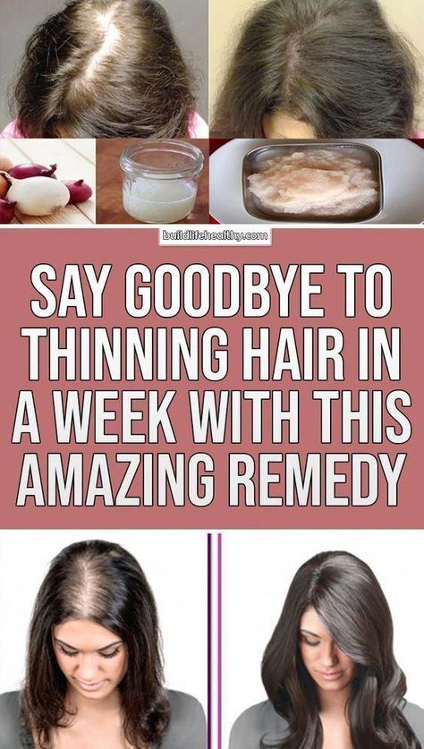 Say Goodbye to thinning Hair in week with this Amazing Remedy Hair Shedding Remedies, Postpartum Hair, Herbal Health, Health Essentials, Thick Hair Remedies, Get Thicker Hair, Home Remedies For Hair, Hair Trim, Essential Oils For Hair