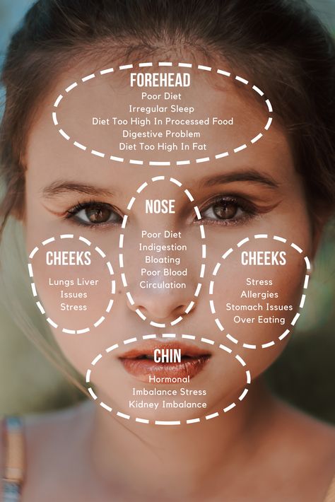 Doctor of traditional Chinese medicine believes that breakouts on varioys areas of the face can reflect different problems in your internal health. This face map will show your problem. Chinese Facial Mapping, Chinese Medicine Face Map, Face Mapping Health, Chinese Medicine Doctor, Chinese Face Map, Chinese Face Reading, Face Map, Internal Health, Tcm Traditional Chinese Medicine