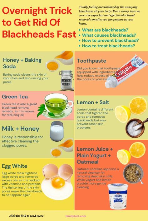 What Causes Blackheads, How To Treat Blackheads, What Are Blackheads, Remove Blackheads From Nose, Blackhead Remedies, Pimples Under The Skin, Green Tea Lemon, Blackheads On Nose, Rid Of Blackheads