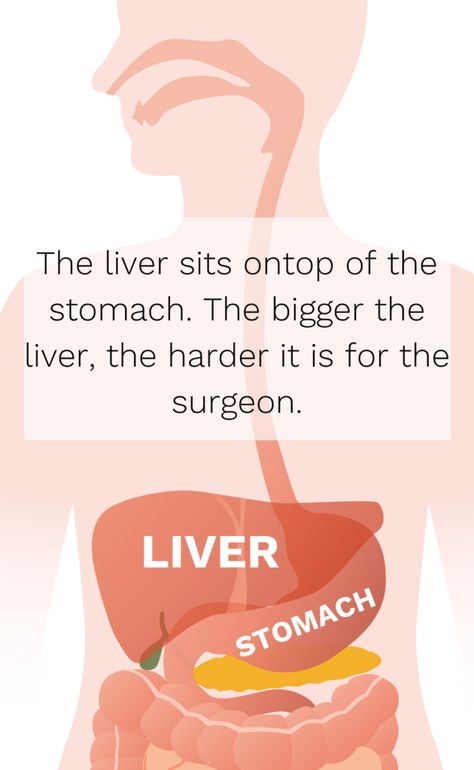 How can I tell if my liver is shrinking before my bariatric surgery? Bariatric Liver Shrinking Diet, Liver Shrinking Diet, Quadrants Of The Abdomen, Healthy Liver Diet, Very Low Calorie Diet, Bariatric Sleeve, Bariatric Surgeon, Bariatric Diet, Liver Diet