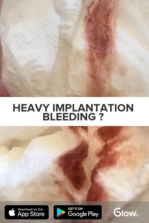 Heavy implantation bleeding ? - Please help? Is this implantion bleeding ? Not due for my period for another 2 weeks. - See the rest of this post by downloading Glow - The Top Rated Fertility & Ovulation Tracker! #ovulation #fertility #discharge #cycle #mucus Brown Discharge Meaning, Implantation Bleed Vs Period, Ratajkowski Style, Emily Ratajkowski Style, Pregnancy Care, Emily Ratajkowski, Top Rated, Fertility, Period