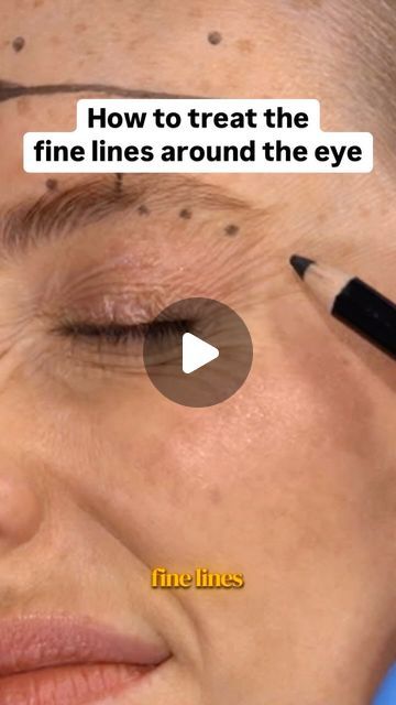 Dr Tim Pearce on Instagram: "Understanding the right techniques for targeting fine lines around the eyes is key to achieving natural results! Learn how I safely treat this delicate area and why it’s essential to know whether lines are caused by volume loss or muscular action. 👨‍⚕️💉

If you don’t feel confident with advanced Botox treatments, I’m hosting a webinar on the 3rd of October, type TOX and I’ll send you the details." Botox Results, Eye Meaning, Skin Care Solutions, Skin Issues, Youthful Skin, Flawless Skin, Skin Care Essentials, Skin Conditions, Skin Health